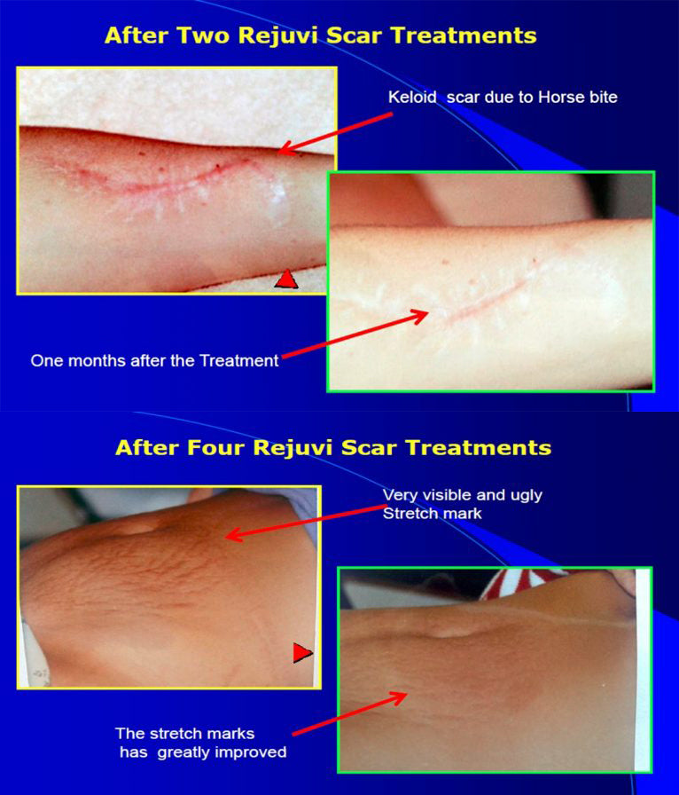 Rejuvi Scar Aftercare Kit - BVShop